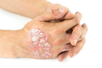 Eine Verschlimmerung der Psoriasis macht das Leben unmöglich
