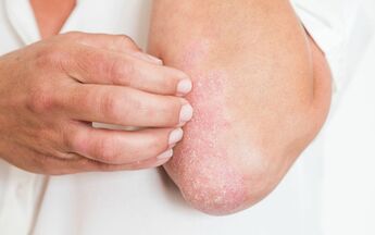 Psoriasis geht mit ständigem Juckreiz einher